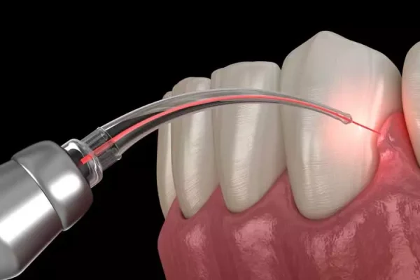 gum-disease-treatment-laser-graphic-opt