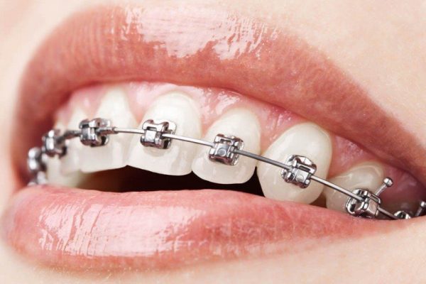 orthodontic treatment