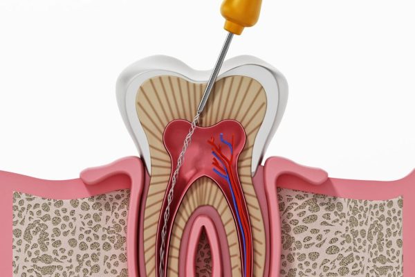 root canal treatment